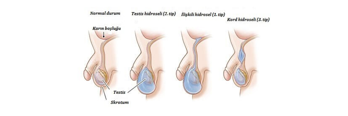 Hidrosel (Su Fıtığı)